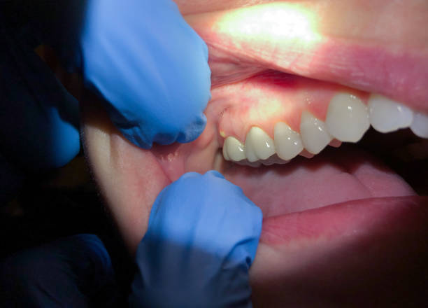 Best Emergency Dentist for Knocked-Out Tooth in Brookside, AL